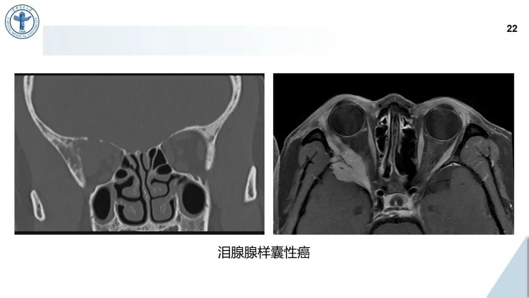 影像PPT - 【病例】鼻中隔腺样囊性癌1例CT及MR影像-21