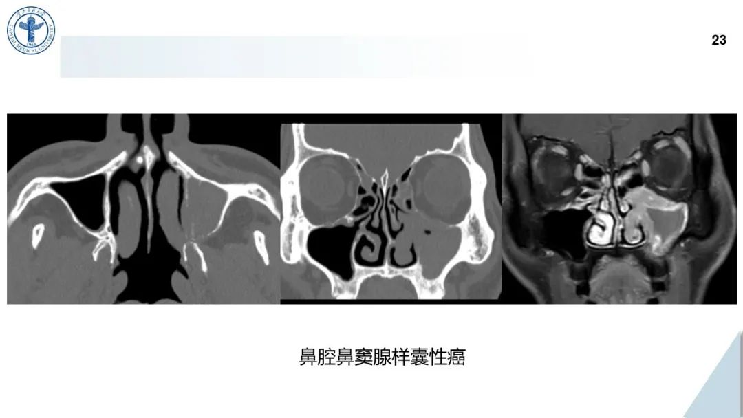 影像PPT - 【病例】鼻中隔腺样囊性癌1例CT及MR影像-22