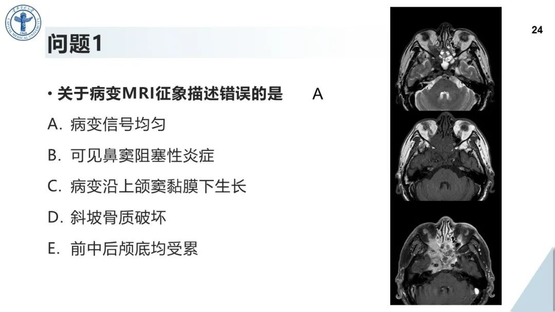 影像PPT - 【病例】鼻中隔腺样囊性癌1例CT及MR影像-23