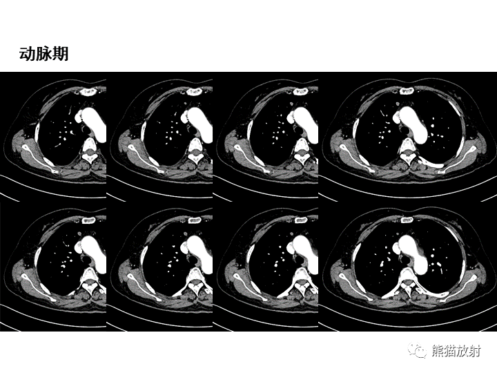 影像PPT - 【病例】肺泡性腺瘤VS原位腺癌-6