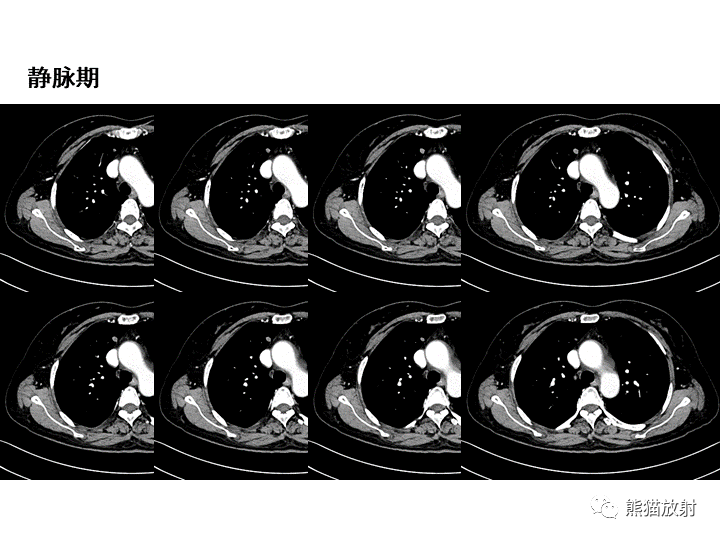 影像PPT - 【病例】肺泡性腺瘤VS原位腺癌-7