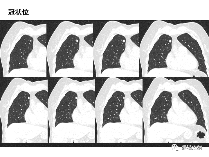影像PPT - 【病例】肺泡性腺瘤VS原位腺癌-8