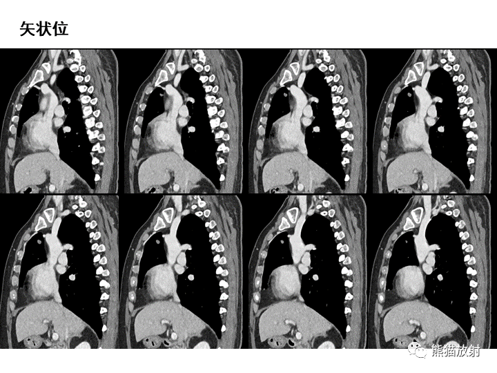 影像PPT - 【病例】肺泡性腺瘤VS原位腺癌-10