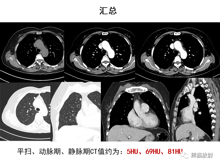 影像PPT - 【病例】肺泡性腺瘤VS原位腺癌-11
