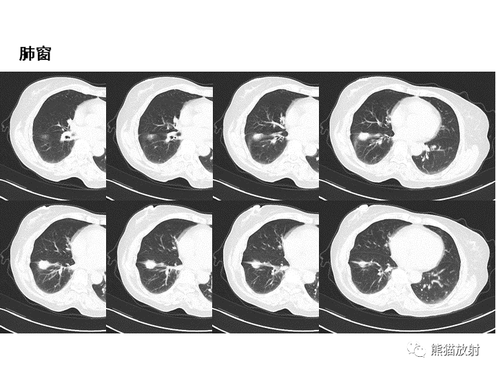 影像PPT - 【病例】肺泡性腺瘤VS原位腺癌-14