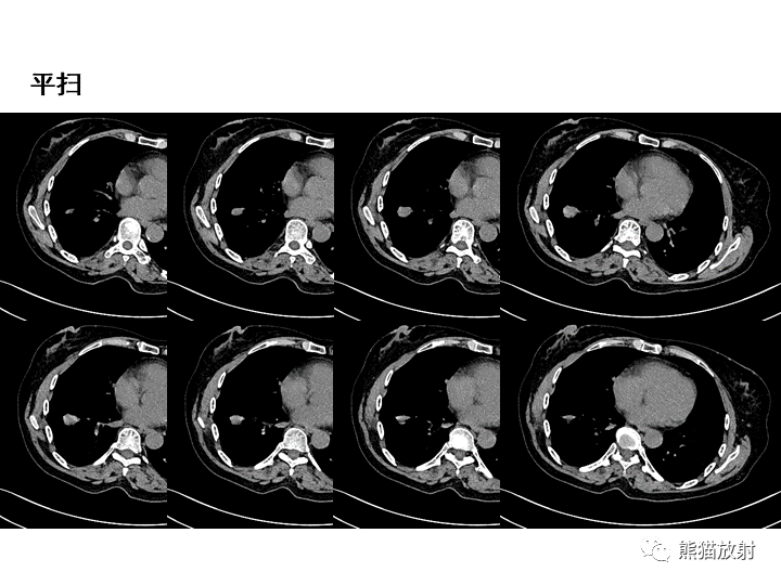 影像PPT - 【病例】肺泡性腺瘤VS原位腺癌-15