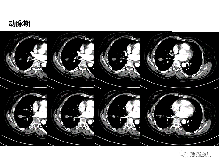 影像PPT - 【病例】肺泡性腺瘤VS原位腺癌-16