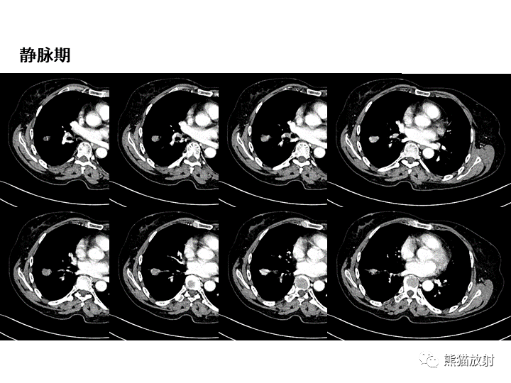 影像PPT - 【病例】肺泡性腺瘤VS原位腺癌-17