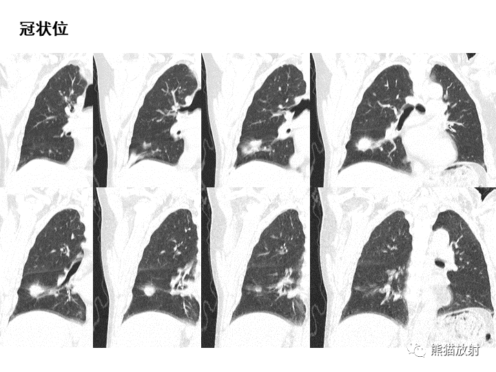 影像PPT - 【病例】肺泡性腺瘤VS原位腺癌-18