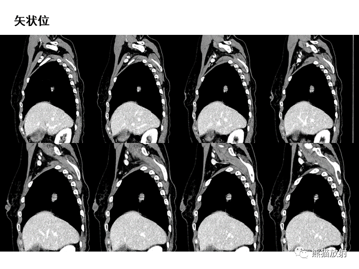 影像PPT - 【病例】肺泡性腺瘤VS原位腺癌-20