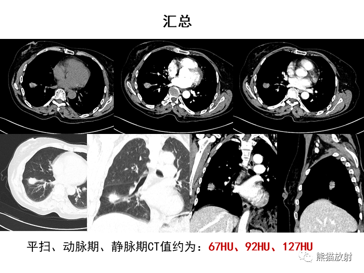 影像PPT - 【病例】肺泡性腺瘤VS原位腺癌-21