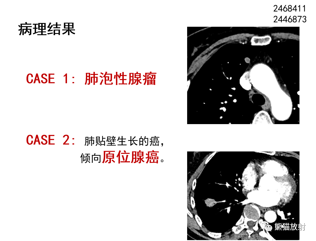 影像PPT - 【病例】肺泡性腺瘤VS原位腺癌-23