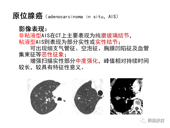 影像PPT - 【病例】肺泡性腺瘤VS原位腺癌-28