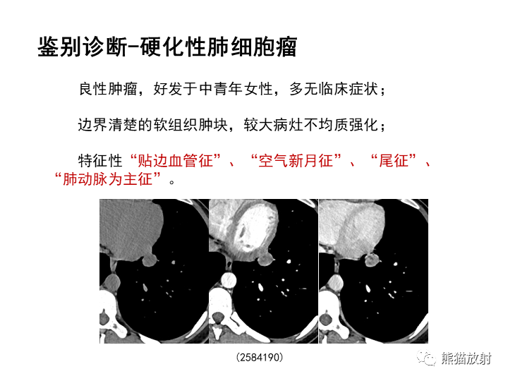 影像PPT - 【病例】肺泡性腺瘤VS原位腺癌-29