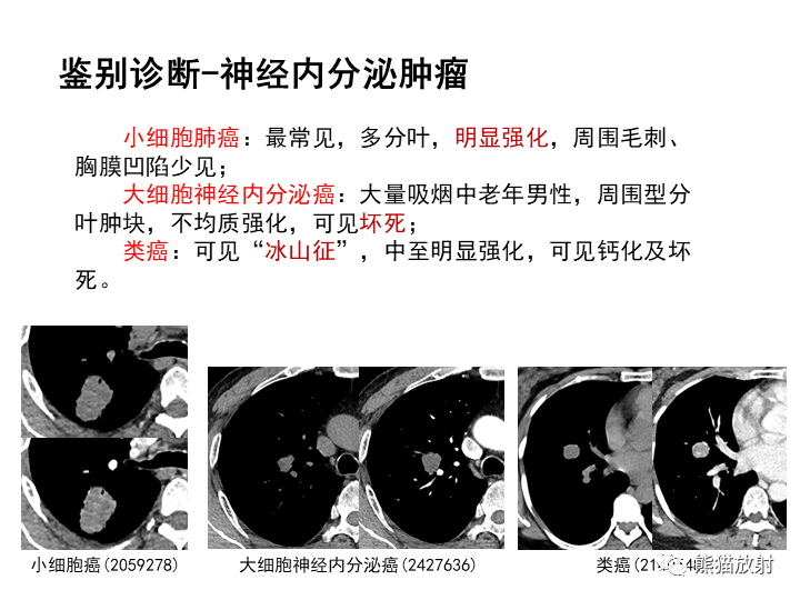 影像PPT - 【病例】肺泡性腺瘤VS原位腺癌-31
