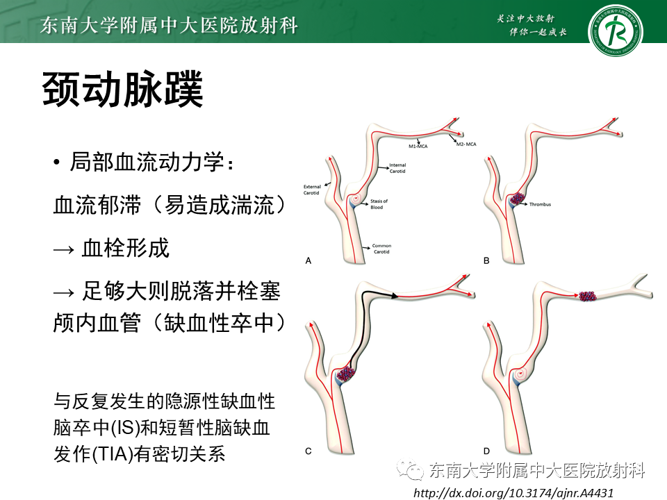 影像PPT - 【病例】颈动脉蹼1例CT影像-5