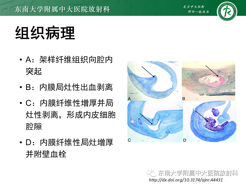 影像PPT - 【病例】颈动脉蹼1例CT影像-8