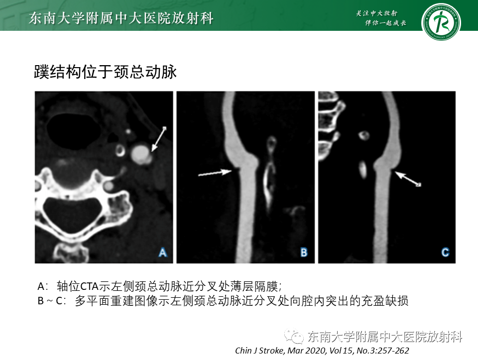 影像PPT - 【病例】颈动脉蹼1例CT影像-9