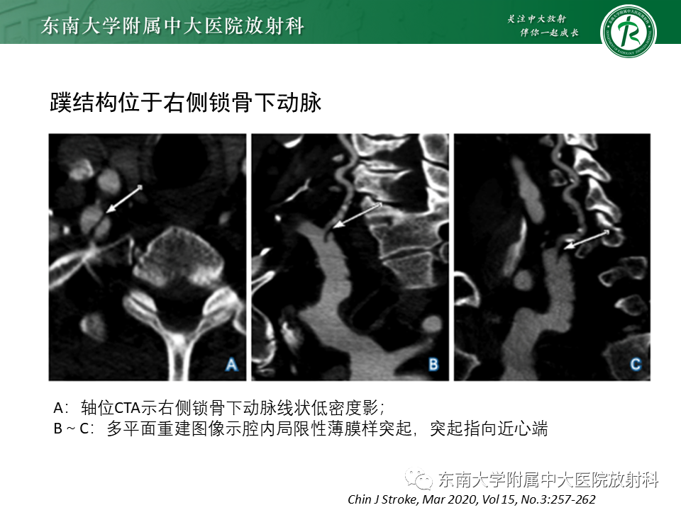 影像PPT - 【病例】颈动脉蹼1例CT影像-10