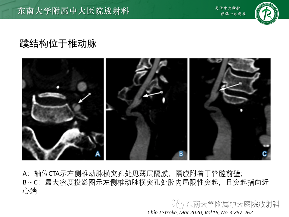 影像PPT - 【病例】颈动脉蹼1例CT影像-11