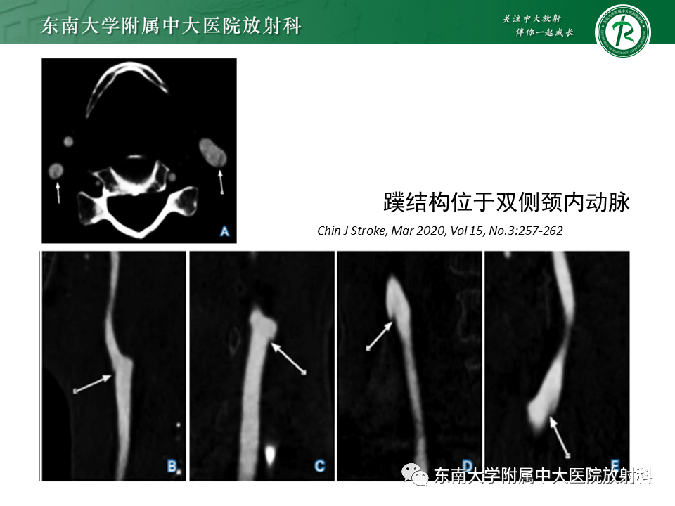 影像PPT - 【病例】颈动脉蹼1例CT影像-12
