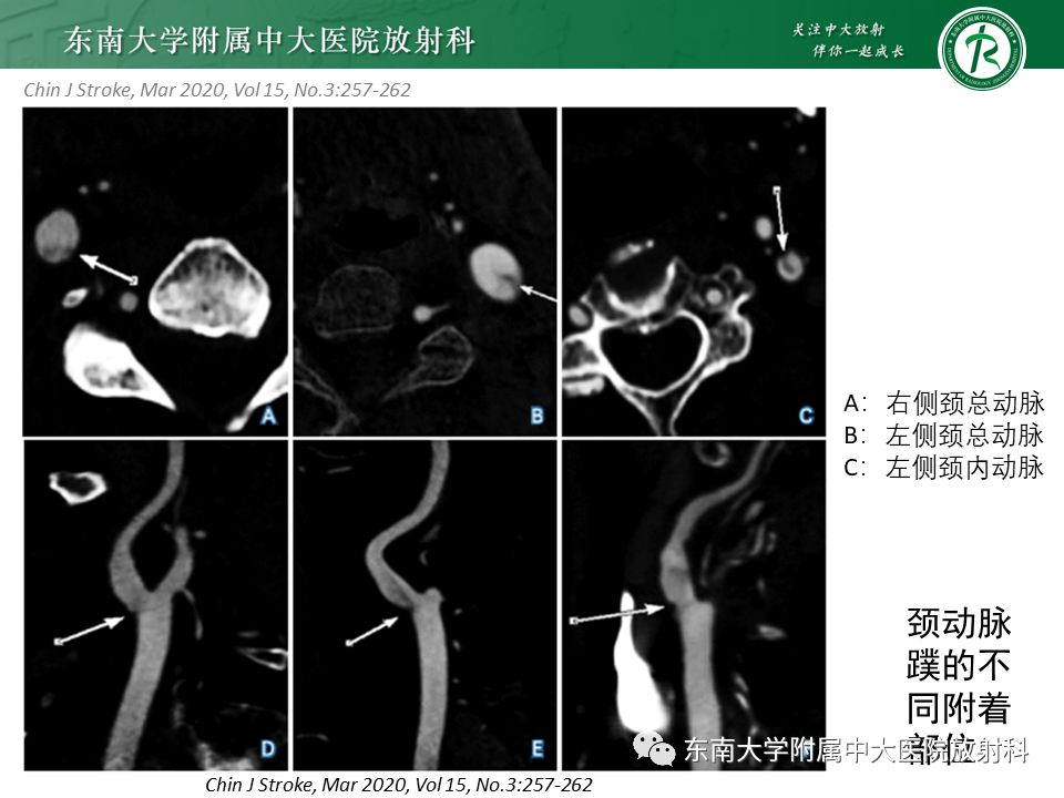 影像PPT - 【病例】颈动脉蹼1例CT影像-13