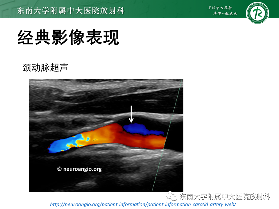影像PPT - 【病例】颈动脉蹼1例CT影像-14
