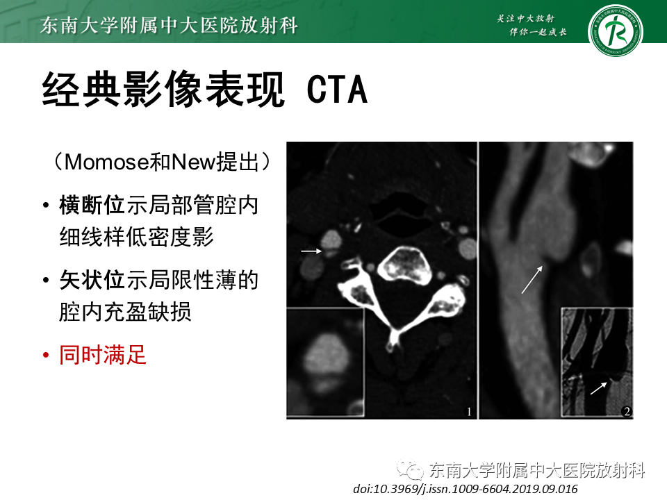 影像PPT - 【病例】颈动脉蹼1例CT影像-15
