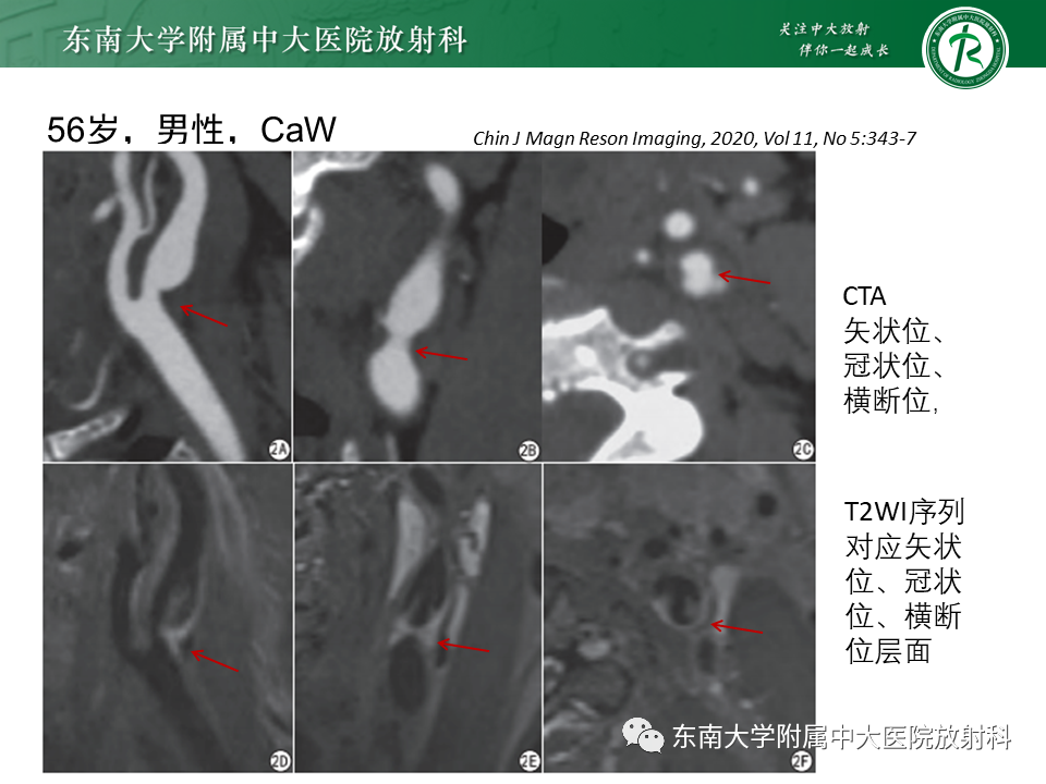 影像PPT - 【病例】颈动脉蹼1例CT影像-19