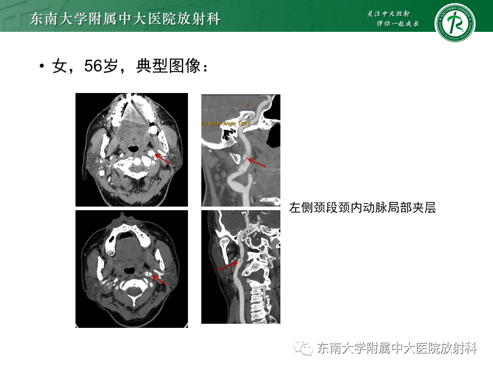 影像PPT - 【病例】颈动脉蹼1例CT影像-23