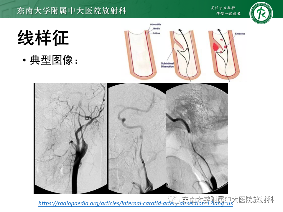 影像PPT - 【病例】颈动脉蹼1例CT影像-24