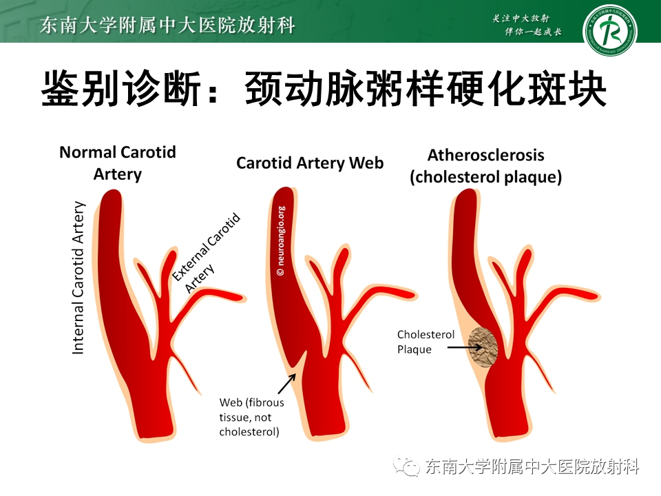 影像PPT - 【病例】颈动脉蹼1例CT影像-25