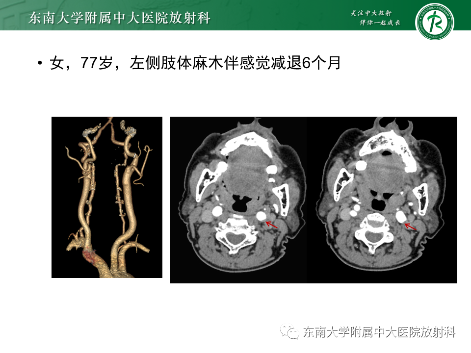 影像PPT - 【病例】颈动脉蹼1例CT影像-26