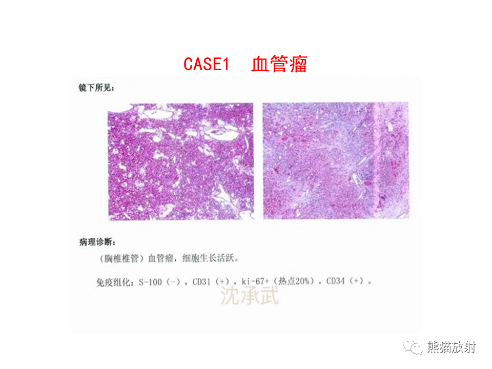 影像PPT - 【病例】椎管内髓外硬膜下血管瘤VS神经鞘瘤-16