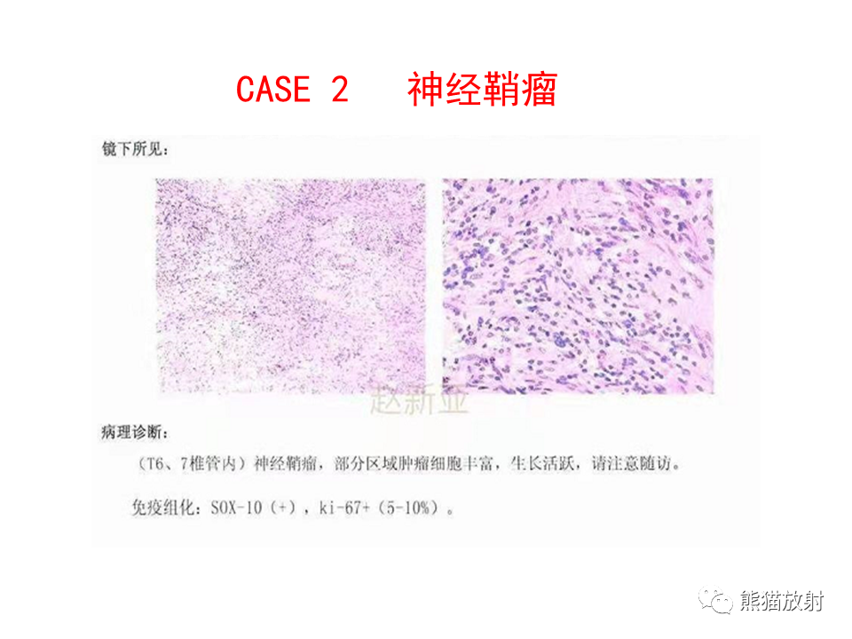影像PPT - 【病例】椎管内髓外硬膜下血管瘤VS神经鞘瘤-17