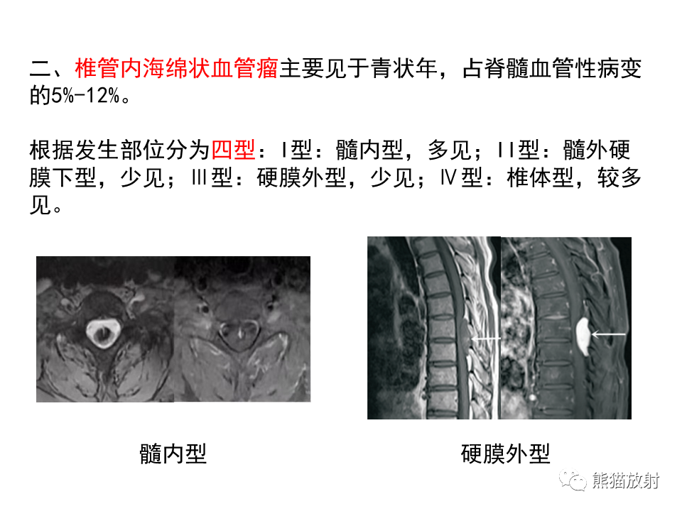 影像PPT - 【病例】椎管内髓外硬膜下血管瘤VS神经鞘瘤-20