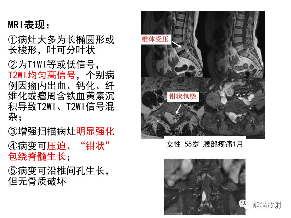 影像PPT - 【病例】椎管内髓外硬膜下血管瘤VS神经鞘瘤-21