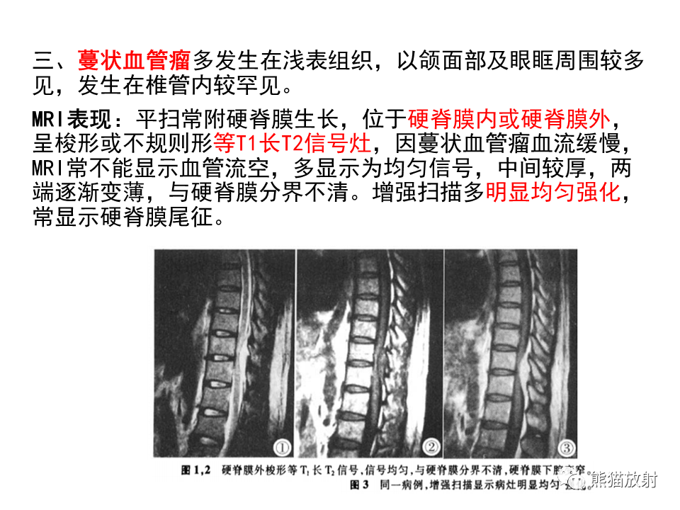 影像PPT - 【病例】椎管内髓外硬膜下血管瘤VS神经鞘瘤-22