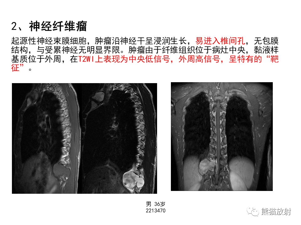 影像PPT - 【病例】椎管内髓外硬膜下血管瘤VS神经鞘瘤-24
