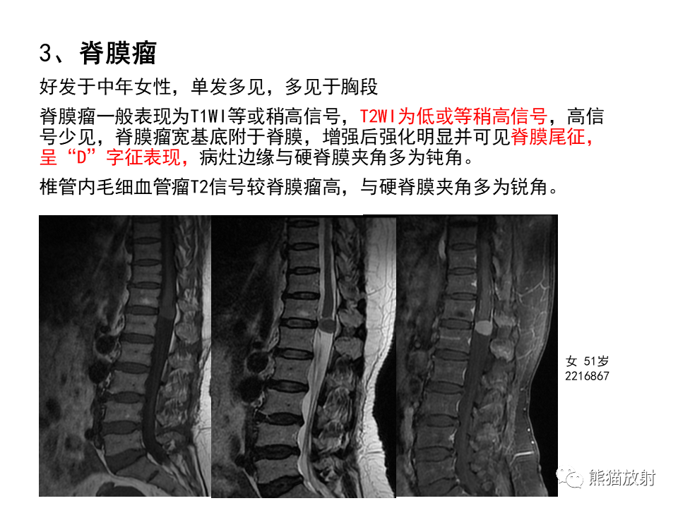 影像PPT - 【病例】椎管内髓外硬膜下血管瘤VS神经鞘瘤-25