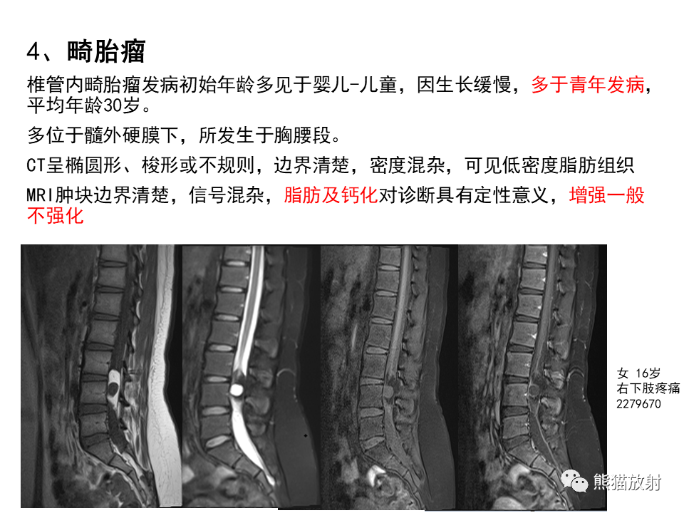影像PPT - 【病例】椎管内髓外硬膜下血管瘤VS神经鞘瘤-26