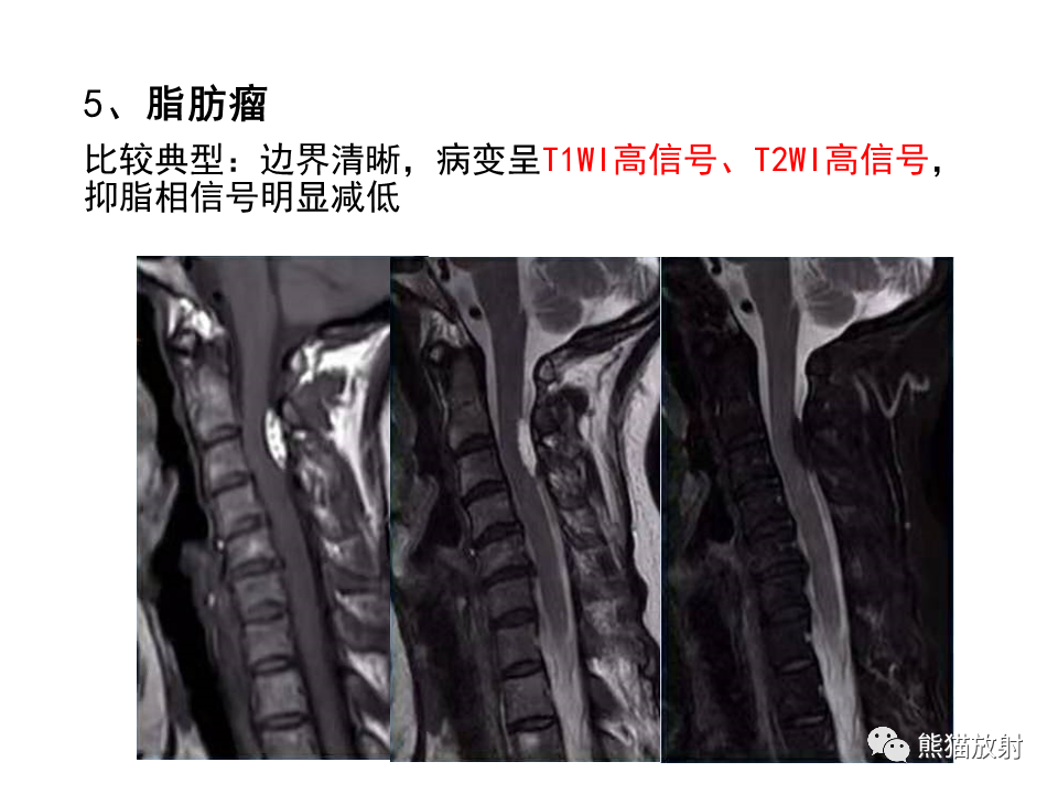 影像PPT - 【病例】椎管内髓外硬膜下血管瘤VS神经鞘瘤-27