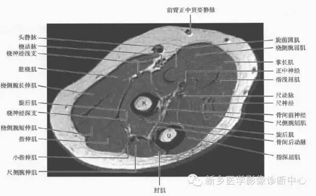 影像PPT - 前臂精细MR断层解剖标注-3