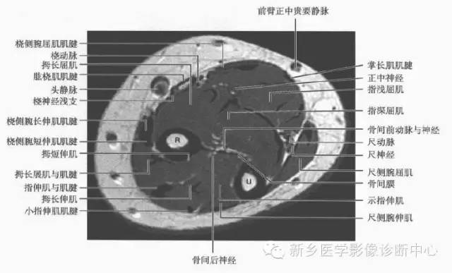 影像PPT - 前臂精细MR断层解剖标注-15