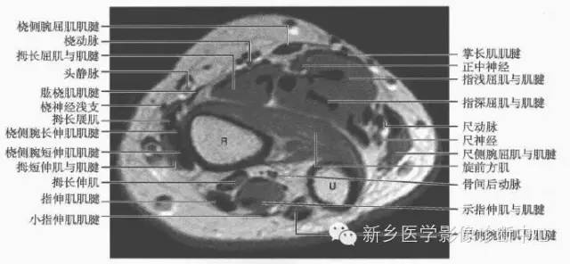 影像PPT - 前臂精细MR断层解剖标注-21