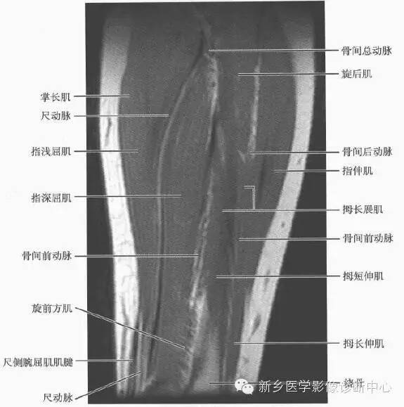 影像PPT - 前臂精细MR断层解剖标注-29
