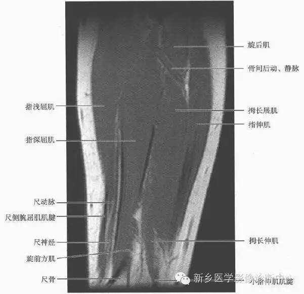 影像PPT - 前臂精细MR断层解剖标注-30