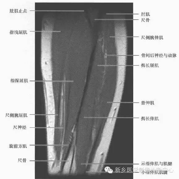 影像PPT - 前臂精细MR断层解剖标注-31