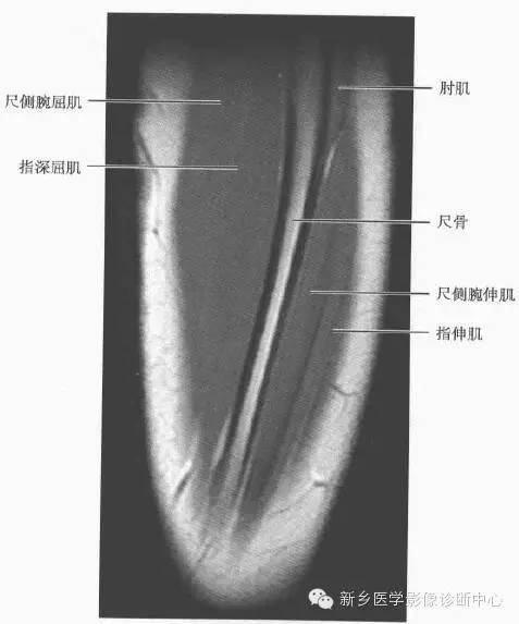 影像PPT - 前臂精细MR断层解剖标注-33