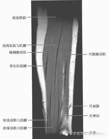 影像PPT - 前臂精细MR断层解剖标注-36